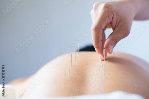 acupuncture treatment