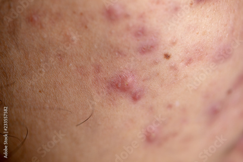 Backgrounds of lesions skin caused by acne on the face in the clinic.