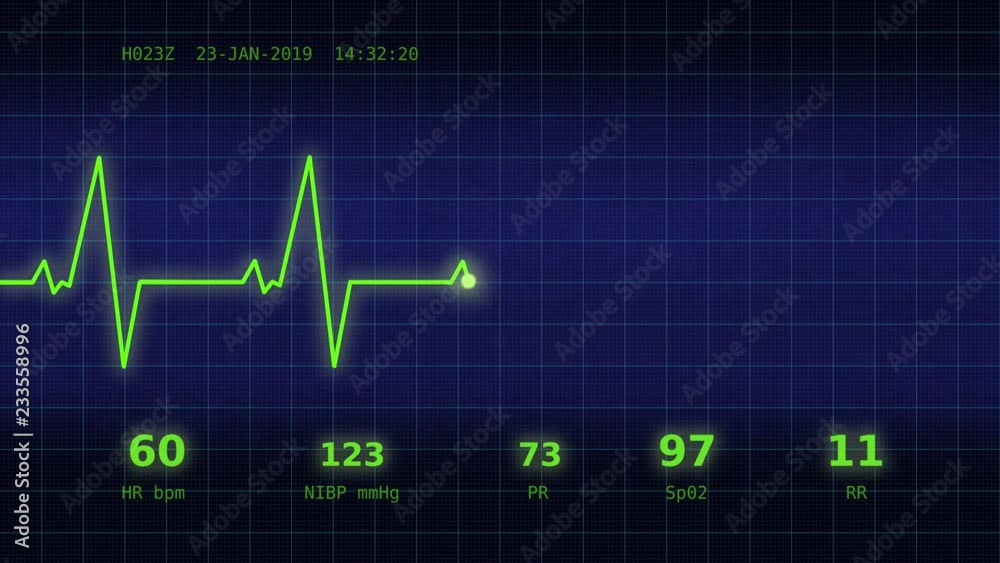A graph of normal heartbeat with additional parameters: heart rate, rhythm, period on a blue monitor viewed straight ahead A graph of normal heartbeat with additional parameters: heart rate, rhythm, period on a blue monitor viewed straight ahead