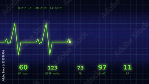A graph of normal heartbeat with additional parameters: heart rate, rhythm, period on a blue monitor viewed straight ahead