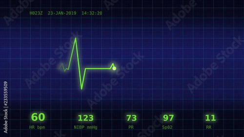A graph of normal heartbeat with additional parameters: heart rate, rhythm, period on a blue monitor viewed straight ahead