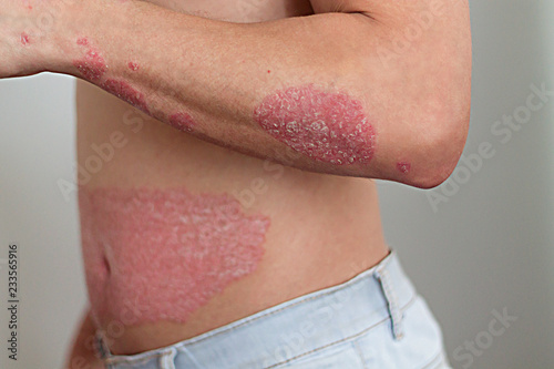 the man on the arm and abdomen psoriasis photo