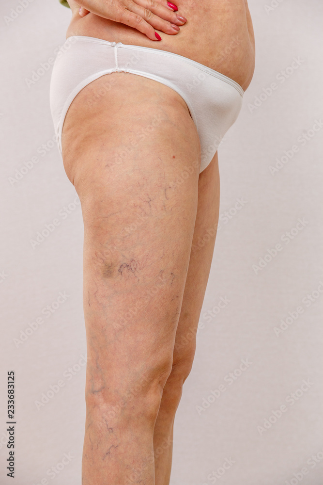 Foto de An elderly woman in white panties shows places on the body with  cellulite and varicose veins on a bright isolated background. A concept for  medicine and cosmetology. do Stock