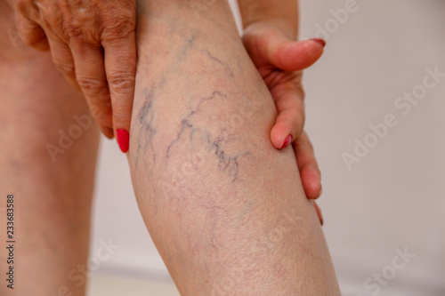An elderly woman in white panties is touching her legs with cellulite and varicose veins on a light isolated background. Concept for medicine and cosmetology.