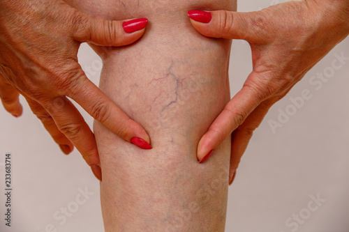An elderly woman in white panties is touching her legs with cellulite and varicose veins on a light isolated background. Concept for medicine and cosmetology. photo