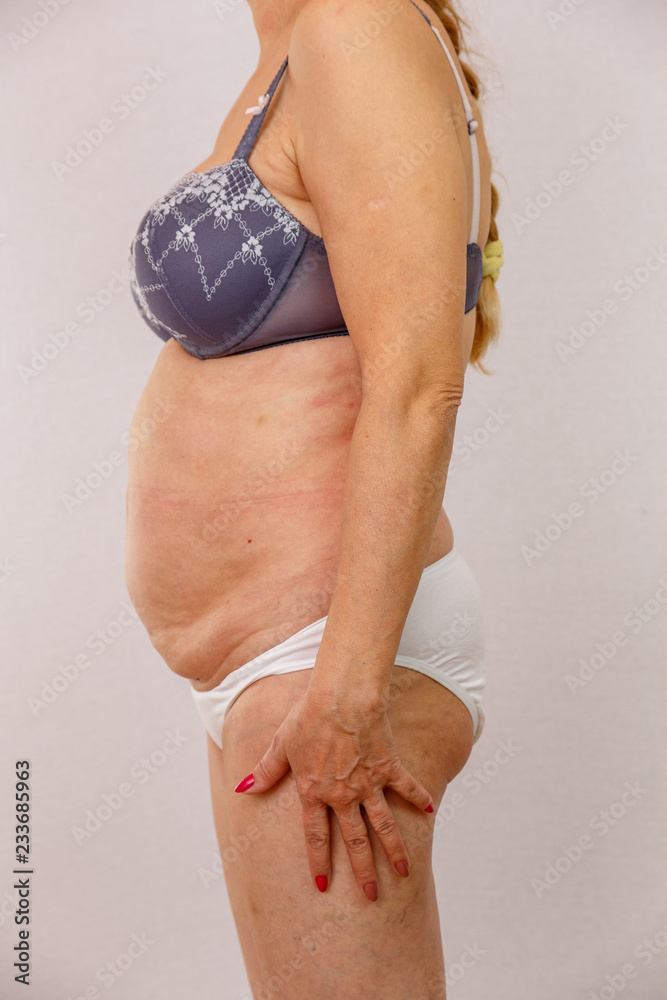 An elderly woman in white panties shows places on the body with cellulite  and varicose veins on a bright isolated background. A concept for medicine  and cosmetology. Stock Photo