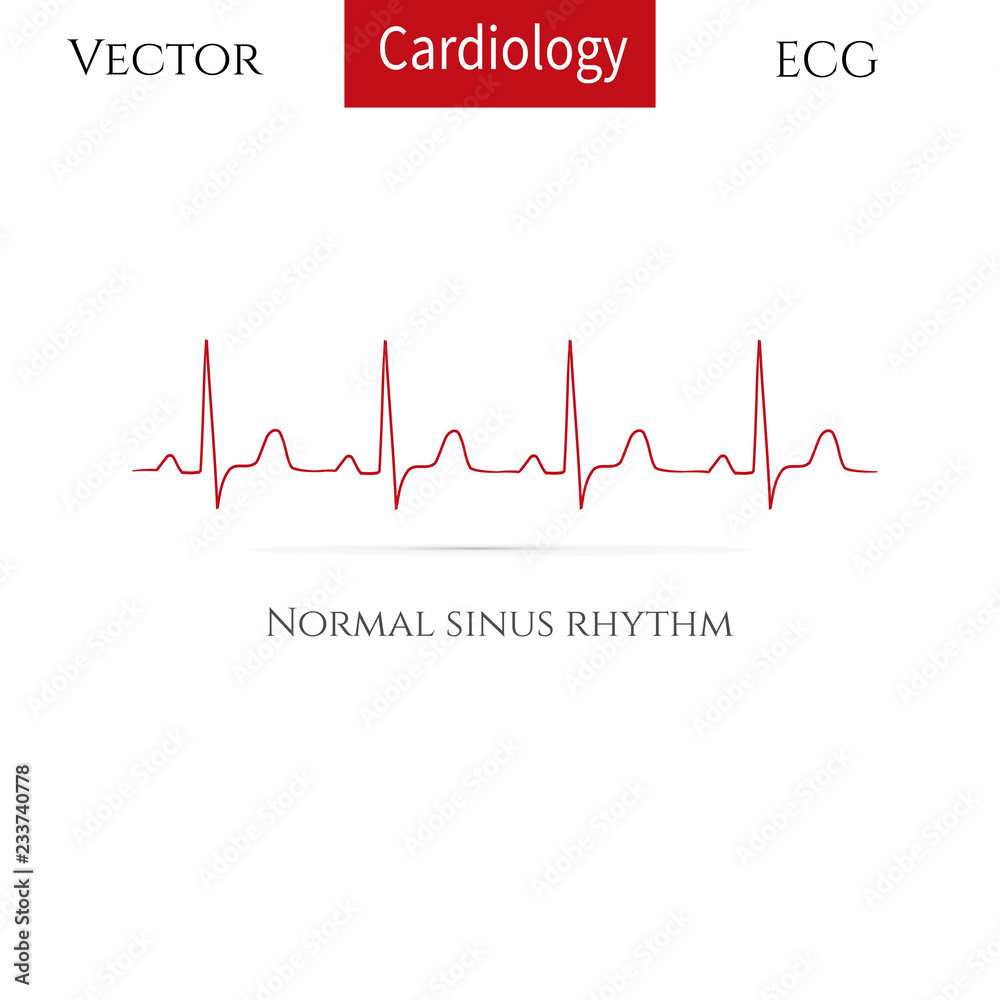 Normal heart rhythm (normal sinus rhythm).