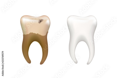 Healthy bright human tooth and old dirty tooth with caries isolated on white, dental health concept illustration