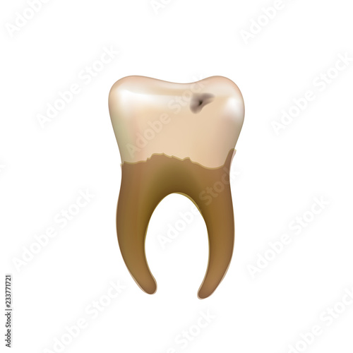 Old sick human tooth with caries isolated on white