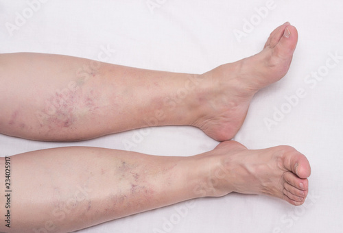 Foto Varicose veins in the legs of a woman, white background, varicose veins on the c