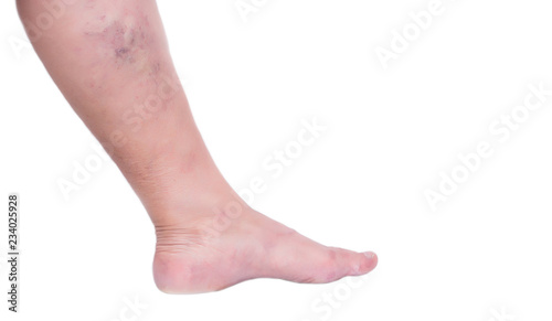 Leg of an elderly woman on a white background with varicose veins, close-up, isolate, phlebeurysm and thrombophlebitis, problem