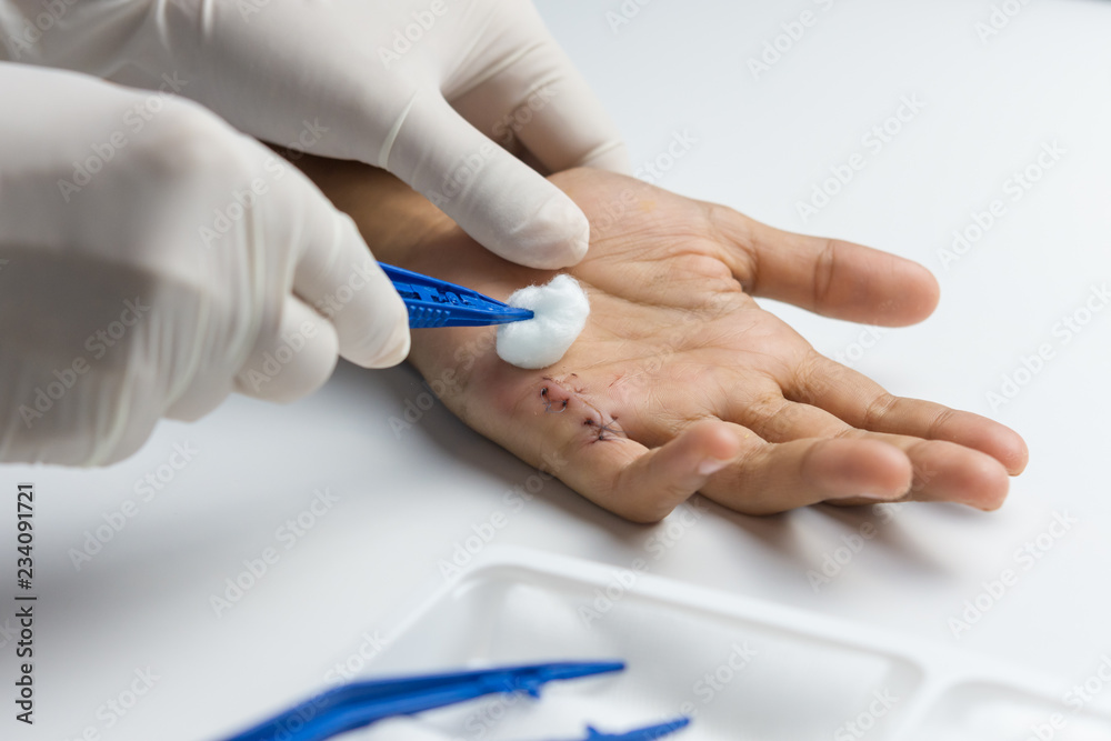 Woman nurse with gloves using cotton wool moistened with alcohol cleaning the wound on the hand of the young man.