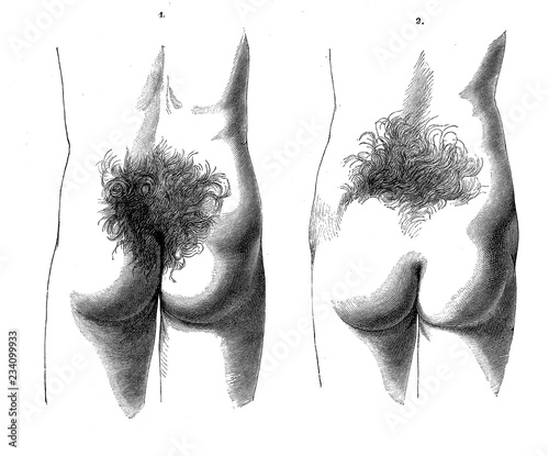 Vintage illustration of anatomy, human  male and female trichosis, hairiness in sacral region