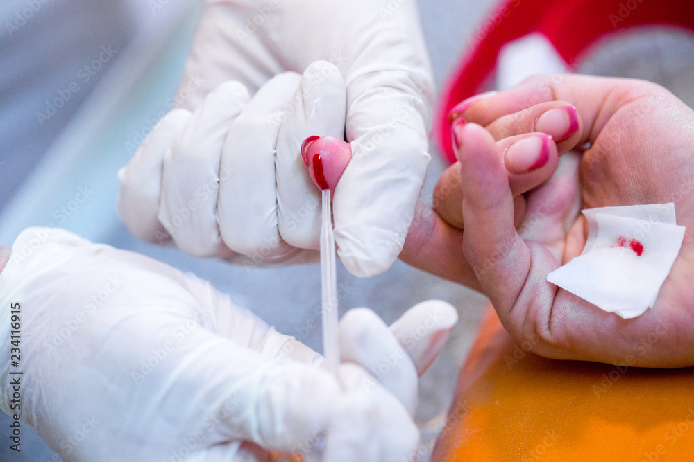 Nurse hands select of dose of blood from a finger woman for rapid testing AIDS and HIV infection. Medical concept: diagnosing, monitoring, treatment disease, hospital, immunization, illness, disease. Nurse hands select of dose of blood from a finger woman for rapid testing AIDS and HIV infection. Medical concept: diagnosing, monitoring, treatment disease, hospital, immunization, illness, disease.