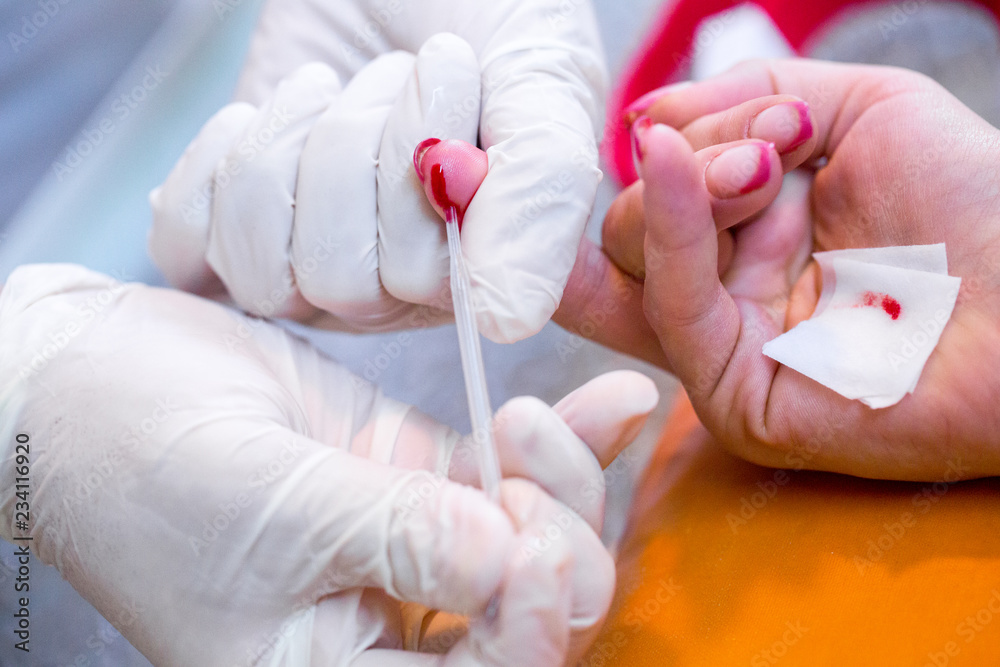 Nurse hands select of dose of blood from a finger woman for rapid testing AIDS and HIV infection. Medical concept: diagnosing, monitoring, treatment disease, hospital, immunization, illness, disease. Nurse hands select of dose of blood from a finger woman for rapid testing AIDS and HIV infection. Medical concept: diagnosing, monitoring, treatment disease, hospital, immunization, illness, disease.