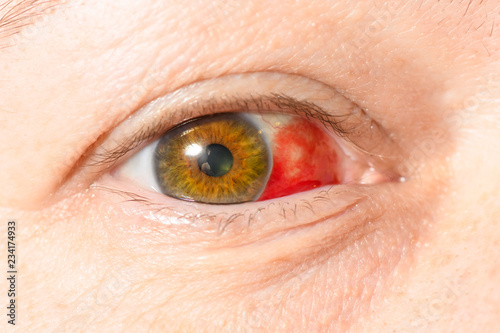 Subconjunctival hemorrhage - hyposphagma. Closeup of woman's face showing red bloodshot eye with browm iris, looked looking straight