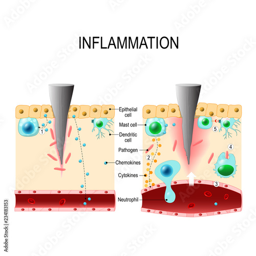 Inflammation. Immune system photo