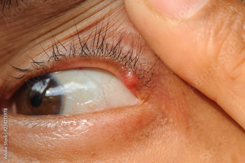 Eye disease hordeolum. photo