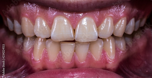 Принти на полотні Healthy human teeth with normal occlusion from frontal view .