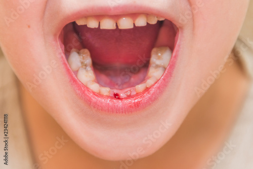 a girl, a child lost a tooth, hole, oral hygiene