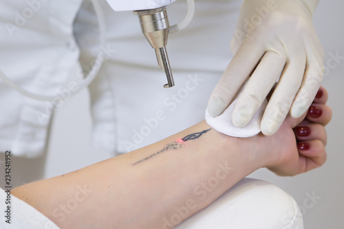 Close-up of laser tattoo removal from woman hand. photo
