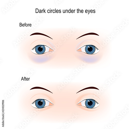 Dark circles under the eyes