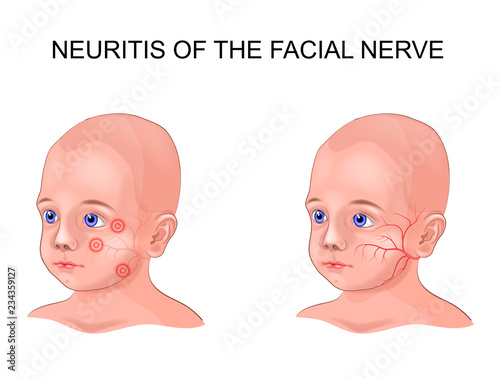 facial nerve neuritis in a child photo