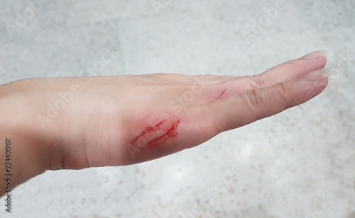 Foreground close-up image of a girl's hand badly cut and bleeding on the side of her palm 