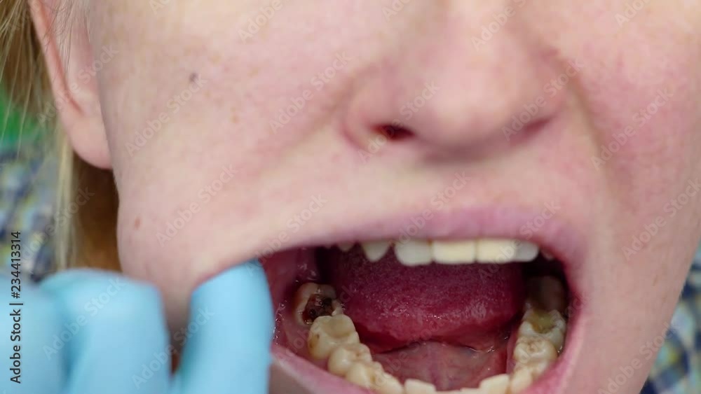 Deep caries, open canals, cleaning canals. Patient at stomatolon on admission, periodontitis treatment Deep caries, open canals, cleaning canals. Patient at stomatolon on admission, periodontitis treatment