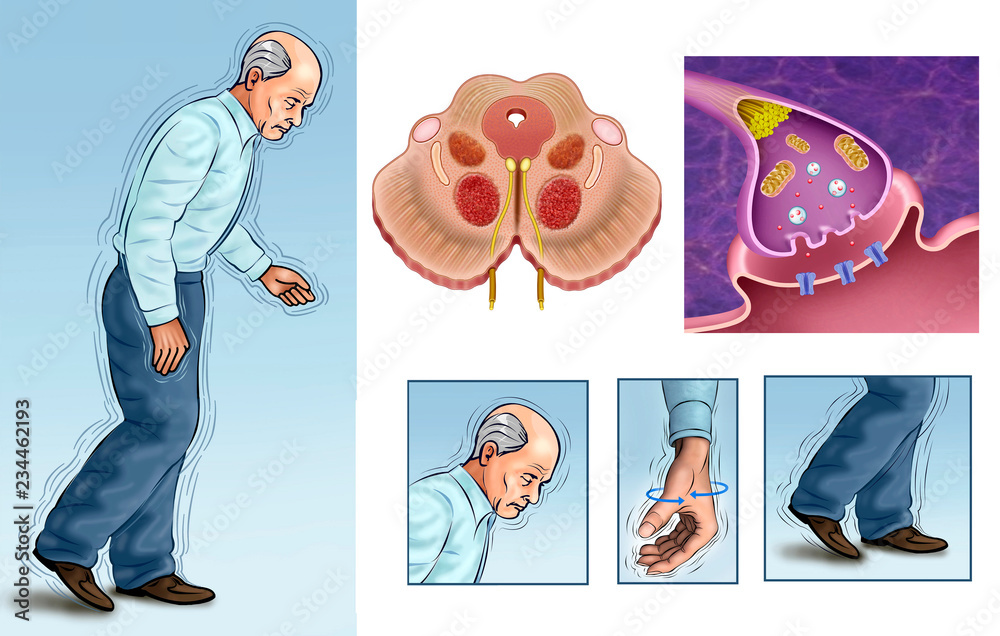 Parkinson's disease Schematic and descriptive composition. Stock ...