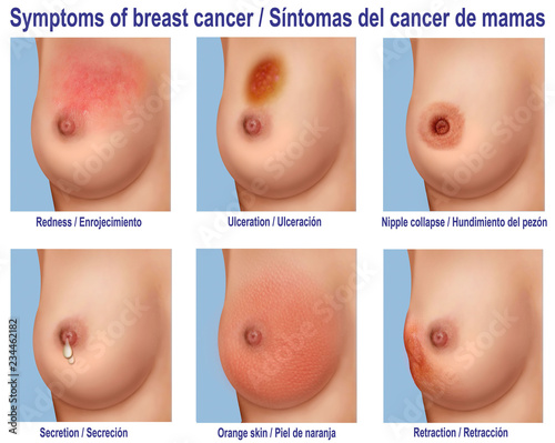 Characteristics of breast cancer