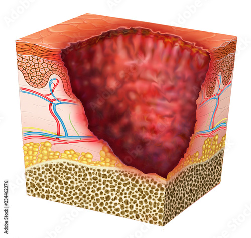 Descriptive illustration of a segment of ulcerated skin. photo