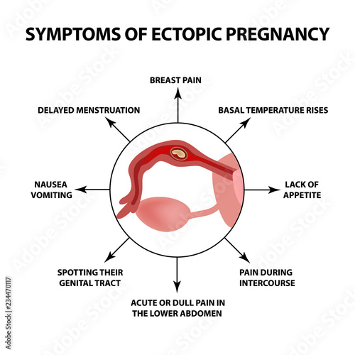 Symptoms of ectopic pregnancy. Infographics. Vector illustration on isolated background. photo