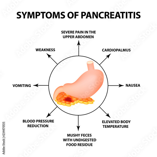 Symptoms of pancreatitis. The structure of the stomach and pancreas. Infographics. Vector illustration on isolated background