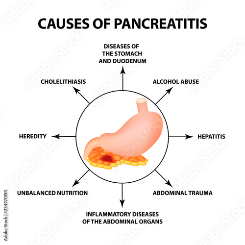 Causes of pancreatitis. The structure of the stomach and pancreas. Infographics. Vector illustration on isolated background photo