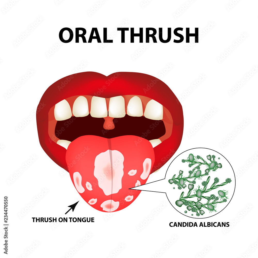 Oral thrush. Candidiasis on the tongue. Fungus in the mouth