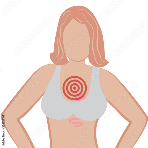 Gastroesophageal reflux desease. Gerd stomach in a human body vector illustration