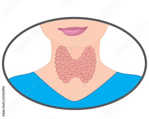  Enlarged Thyroid. Endocrine disfunction vector illustration on a white background