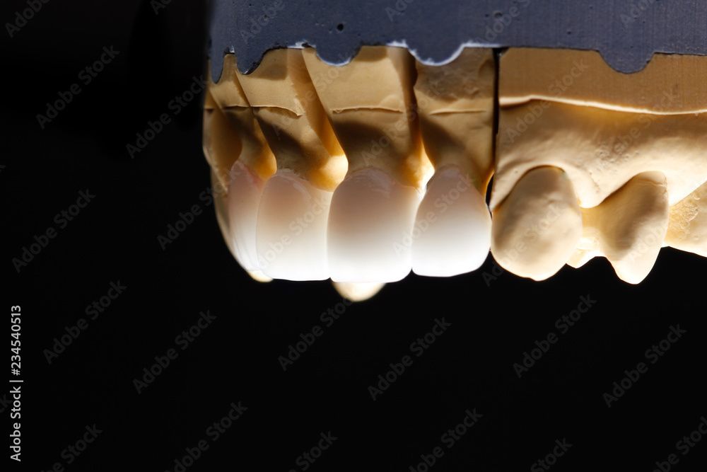 Fototapeta premium White front teeth veneers on diagnostic model on dark background. Close up.