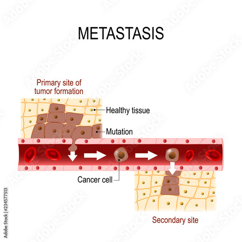 Cancer cells squeezes through blood vessel during Metastases