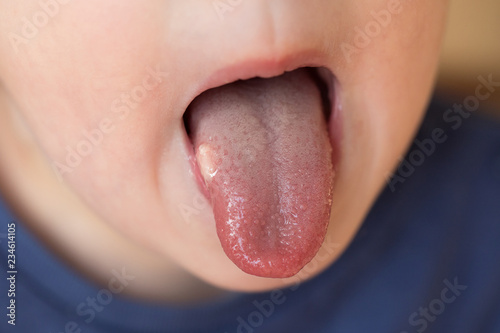 Close-up of child with aphtha or stomatits on mouth photo
