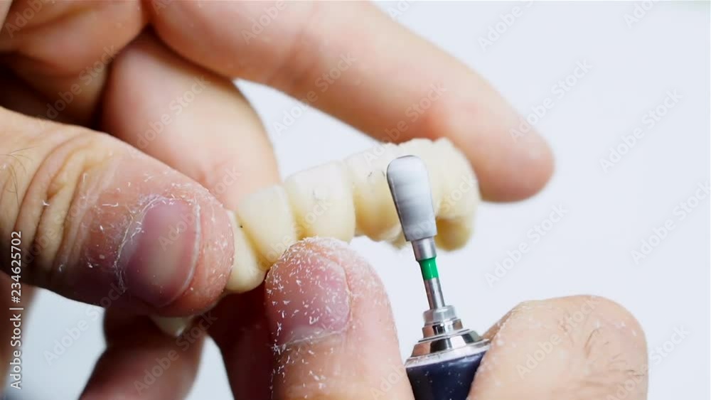 Dental technician grinds and modifies, temporary prosthesis after dental freezer