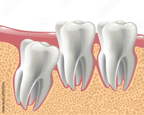 realistic 3D teeth, and wisdom tooth problems