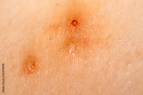 Close up of Molluscum Contagiosum also called water wart photo