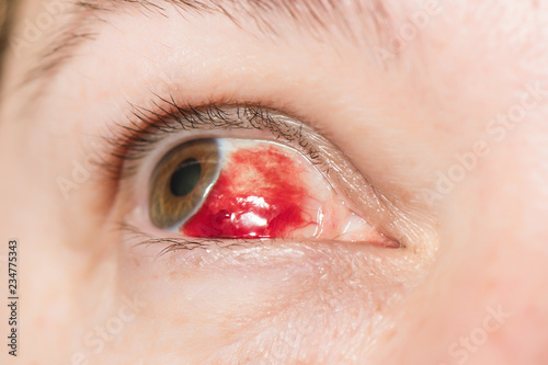 Subconjunctival hemorrhage - hyposphagma. Closeup of woman's face showing red bloodshot eye with browm iris, looked up and left