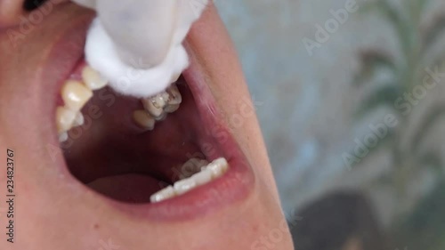 dental tooth extraction of male patient photo