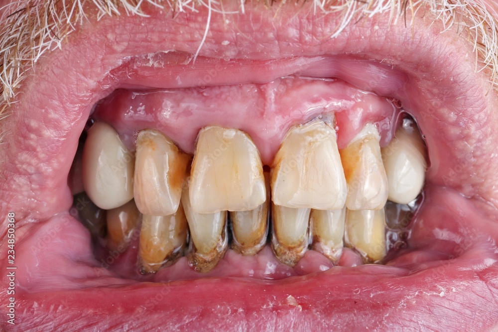 The teeth of an elderly man are spoiled by caries, tartar and poor nutrition  macro