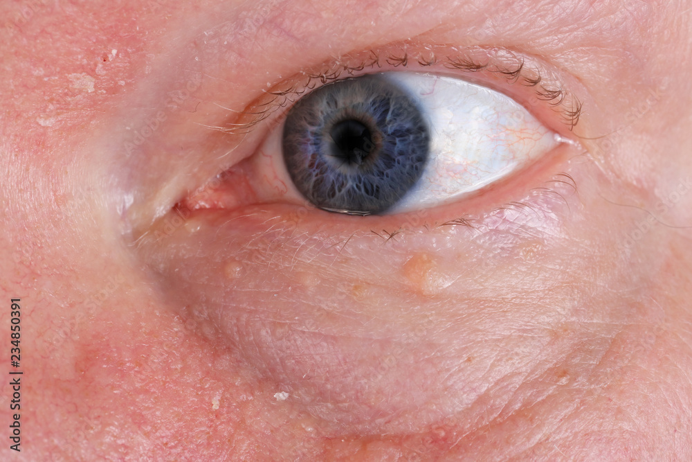 Fototapeta premium Sore dry skin and blind eye on the face of an old elderly man