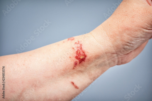 chemical burn on the skin from touching the plant 'burning Bush', Dictamnus