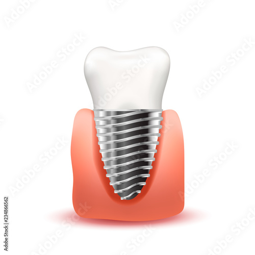 Realistic tooth implant with metallic screw in pink gum isolated on white